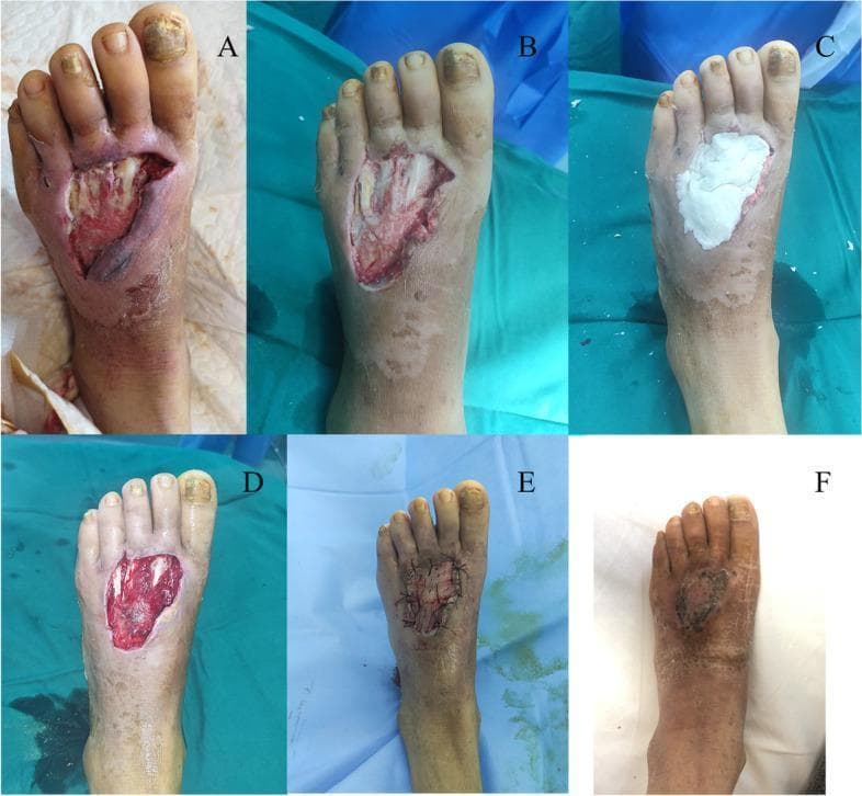 A sequence of six clinical photographs (A-F) documenting the surgical management of a Wagner grade 2 diabetic foot ulcer on the dorsal midfoot of a 45-year-old female. Image A shows the initial presentation: a large, open ulcer with irregular borders, exposed subcutaneous tissue, and signs of infection/necrosis. Image B depicts the wound bed following surgical debridement of non-viable and infected soft tissue. Image C illustrates the application of white antibiotic bone cement (PMMA) into the defect to manage local infection. Image D shows the wound bed after two weeks of antibiotic cement treatment, exhibiting healthy-appearing granulation tissue. Image E demonstrates the reconstruction phase, with a split-thickness skin graft secured over the defect using sutures. Image F presents the final clinical outcome at follow-up, showing complete wound closure and epithelialization with stable skin integrity and residual post-inflammatory hyperpigmentation. This series illustrates a multi-stage approach for complex diabetic foot infections including debridement, local antibiotic delivery, and skin grafting.