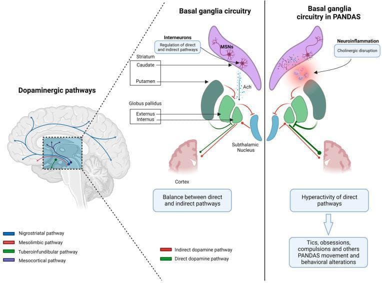 Educational medical diagram illustrating the pathophysiology of Pediatric Autoimmune Neuropsychiatric Disorders Associated with Streptococcal Infections (PANDAS) within the basal ganglia. The image is divided into three sections. On the left, a sagittal view of the human brain maps the four major dopaminergic pathways: nigrostriatal (blue), mesolimbic (red), tuberoinfundibular (green), and mesocortical (purple). The center and right panels provide a comparative schematic of basal ganglia circuitry. The 'Normal' circuit shows the functional balance between the direct and indirect pathways, highlighting the roles of the striatum (caudate and putamen), medium spiny neurons (MSNs), acetylcholine (Ach) interneurons, and the globus pallidus (externus and internus). In contrast, the 'PANDAS' circuit depicts neuroinflammation and cholinergic disruption in the dorsal striatum. This pathological state results in decreased Ach modulation and fewer distinct MSNs, leading to hyperactivity of the direct pathway. The diagram concludes by linking this physiological imbalance to clinical manifestations, including tics, obsessions, and compulsions typical of PANDAS syndrome.