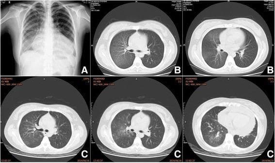 This composite figure presents serial diagnostic imaging of the chest, including a posteroanterior chest X-ray (Panel A) and multiple axial computed tomography (CT) lung window slices (Panels B and C) spanning approximately five months. The primary finding across all modalities is a persistent, localized area of ground-glass opacity (GGO) involving the right lung lobes. In Panel A, the chest radiograph shows increased hazy density in the right middle and lower lung zones without a discrete mass or consolidation. The subsequent axial CT images in Panel B (obtained 10 days later) and Panel C (obtained 5 months later) confirm diffuse, geographic ground-glass opacities within the right lung parenchyma. Notably, the underlying bronchovascular structures remain visible through the hazy density, which is characteristic of GGO rather than dense consolidation. The longitudinal nature of these images demonstrates the chronic persistence of these right-sided pulmonary exudative changes. These findings are clinically relevant for evaluating chronic interstitial processes, localized inflammatory conditions, or rare disorders such as chylous reflux syndrome affecting the pulmonary system.