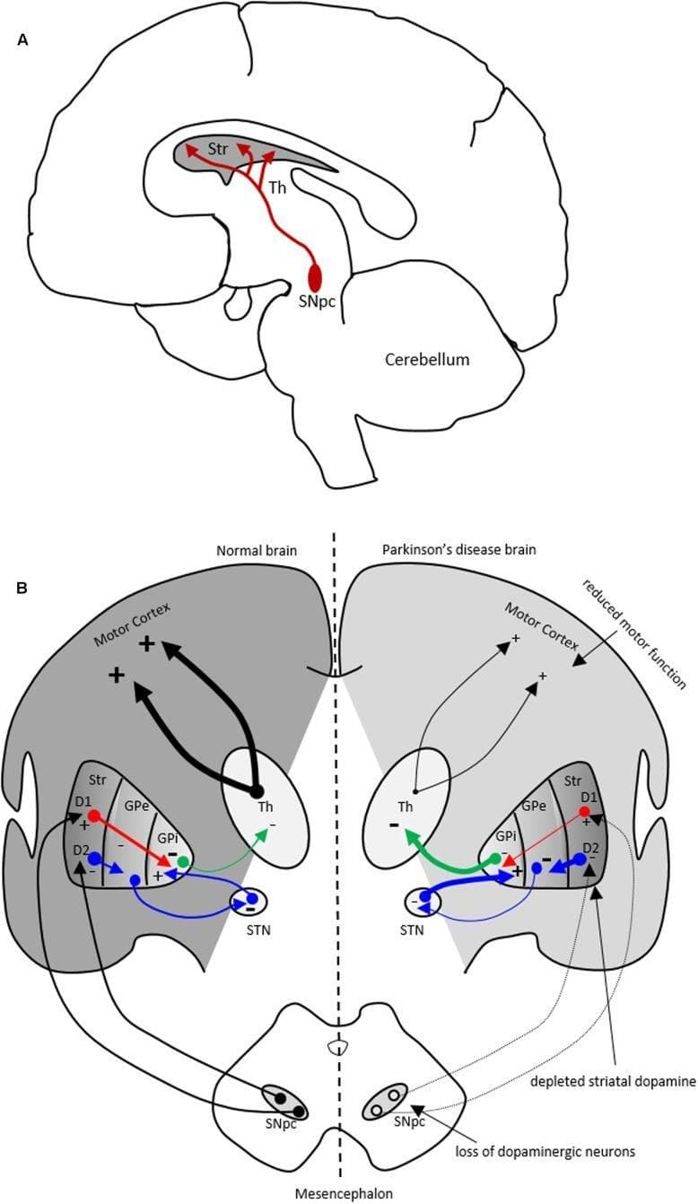 Educational diagram illustrating the pathophysiology of Parkinson's disease (PD) through neuroanatomical pathways and motor circuitry. Part A shows a sagittal anatomical diagram of the human brain identifying the nigrostriatal dopaminergic pathway. Red arrows represent dopamine projections originating from the substantia nigra pars compacta (SNpc) in the midbrain to the striatum (Str) and thalamus (Th). Part B provides a side-by-side comparison chart of motor basal ganglia circuitry in a 'Normal brain' versus a 'Parkinson's disease brain.' The schematic highlights the direct (D1) and indirect (D2) pathways involving the striatum (Str), globus pallidus externa (GPe), subthalamic nucleus (STN), and globus pallidus interna (GPi). In the PD brain, the diagram visually demonstrates the loss of dopaminergic neurons in the SNpc and depletion of striatal dopamine. Changes in line thickness indicate altered signaling intensities: decreased inhibitory input to the GPi and increased inhibitory output (green arrow) from the GPi to the thalamus. This increased inhibition leads to reduced thalamocortical excitation to the motor cortex, explaining the clinical manifestation of reduced motor function characteristic of PD.