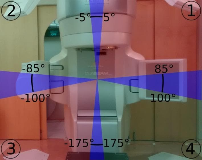 An educational diagram superimposed on a clinical photograph illustrating the geometry of a room-mounted dual X-ray imaging system used in radiotherapy. The image identifies four primary components: X-ray detectors labeled '1' and '2' in the upper corners, and X-ray sources labeled '3' and '4' in the lower corners. Colored shaded regions mapped over the central treatment gantry indicate imaging capabilities relative to gantry rotation angles. Blue shaded areas (centered around -175° to 175°, -5° to 5°, -85° to -100°, and 85° to 100°) represent sectors where stereoscopic imaging is available. Red shaded regions indicate monoscopic imaging capability using the right-side X-ray tube, while green shaded regions indicate monoscopic imaging using the left-side tube. This visualization demonstrates how the rotating treatment gantry periodically obstructs the X-ray pathways, necessitating a switch between stereoscopic and monoscopic target tracking during Volumetric Modulated Arc Therapy (VMAT).