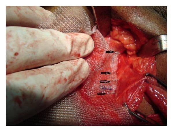 This intraoperative clinical photograph demonstrates a surgical field during an inguinal hernia repair. The image captures the fixation of a white, macroporous polypropylene mesh to the underlying anatomical structures. Black arrowheads highlight a linear series of stainless steel surgical staples, spaced approximately 1-2 cm apart, which anchor the mesh inferiorly along the inguinal ligament. A gloved hand and surgical retractors are visible, maintaining exposure and tension on the mesh during the procedure. The surrounding tissues show typical surgical hyperemia and exposure of the inguinal canal posterior wall. This visual illustrates the tension-free hernioplasty technique (Lichtenstein repair) specifically focusing on the mechanical fixation method using a skin stapler as an alternative to traditional polypropylene sutures for mesh stabilization. The target audience includes surgical residents and medical students learning about inguinal anatomy and prosthetic mesh fixation techniques in general surgery.