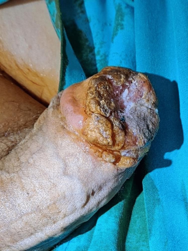 This clinical photograph displays a primary skin lesion involving the glans penis in a circumcised adult male. The lesion is characterized by a significant exophytic and verrucous (wart-like) growth, primarily located on the distal aspect of the glans. It exhibits a highly heterogeneous surface with areas of hyperkeratosis, thick yellowish-brown crusting, and focal gray-white scaling. The central portion of the lesion appears irregular and erosive, with mixed fleshy pink and white plaque-like features. The margins are asymmetrical and poorly defined, showing infiltration into the glans tissue and potential extension toward the proximal penile shaft. The urethral meatus is obscured by the progressive proliferation. In the clinical context of Pseudoepitheliomatous Keratotic and Micaceous Balanitis (PKMB) progressing to verrucous carcinoma, this image illustrates high-risk features for malignancy, including its hard, nodular appearance and resistance to conservative therapy. The image serves as a teaching tool for dermatologic oncology and urology in identifying potentially malignant penile transformations.
