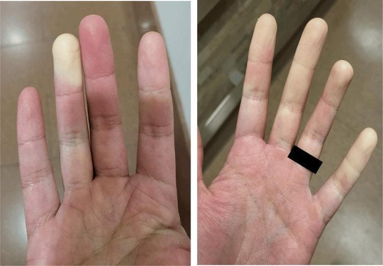 Clinical photograph of a patient's hands demonstrating the characteristic triphasic color changes associated with Raynaud’s phenomenon. The left image shows significant pallor (white phase) in the index finger, representing digital vasospasm and ischemia, contrasted against the erythema (red phase) of the adjacent middle finger, suggesting reperfusion. The right image shows more diffuse, patchy pallor across several digits including the index and ring fingers. These visual findings are hallmark clinical signs of Raynaud’s phenomenon, which may occur as a primary condition or secondary to autoimmune connective tissue diseases. In this clinical context, the findings are associated with a patient positive for anti-centromere antibodies and diagnosed with an autoimmune hepatitis (AIH) and primary biliary cholangitis (PBC) overlap syndrome. The image serves as an educational example of episodic vasospastic disorders and their physical manifestations in the distal extremities.