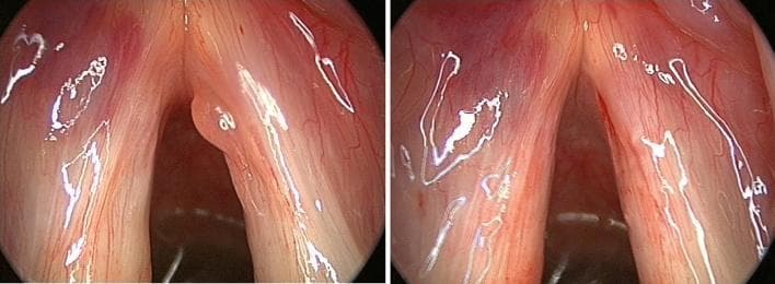 This clinical comparison shows two endoscopic laryngoscopy frames demonstrating complications of suspension microlaryngoscopy. The left frame (pre-operative) displays a distinct, smooth-surfaced polyp on the medial margin of the right vocal fold. Concurrently, a faint, pale red post-intubation hematoma is visible on the anterolateral aspect of the left vocal fold. The right frame (post-operative) shows the same anatomical region after surgical excision of the right vocal fold polyp. Notably, the hematoma on the left vocal fold has progressed, appearing larger and deeper red/purple in color, indicating acute vascular congestion or hemorrhage likely secondary to laryngeal instrumentation or intubation trauma. The vocal folds otherwise appear pinkish-white with visible longitudinal vascular patterns. This image serves as an educational example of minor, temporary surgical complications in otolaryngology, specifically distinguishing between a primary pathology (vocal fold polyp) and iatrogenic trauma (post-intubation hematoma).