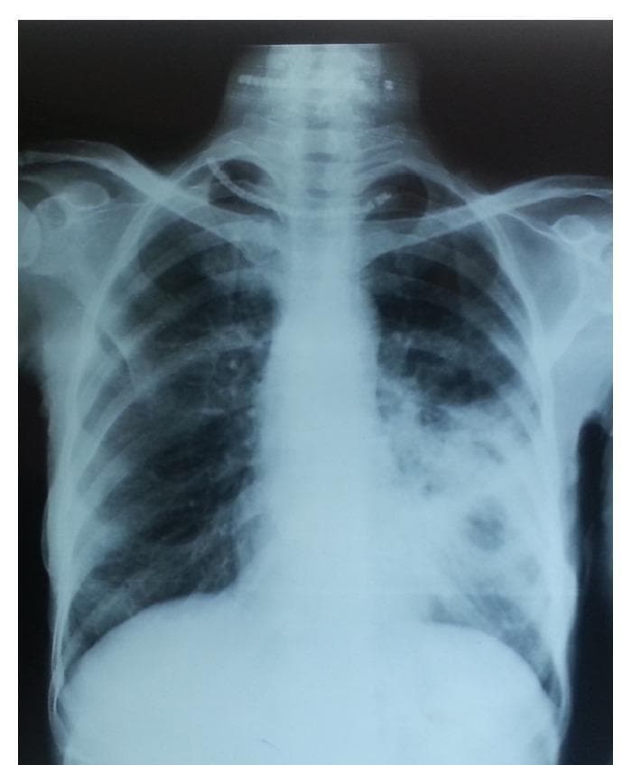 This diagnostic image is a posteroanterior (PA) chest X-ray illustrating a case of moderately advanced pulmonary tuberculosis. The primary pathology is localized in the right lung field, characterized by disseminated heterogeneous opacities of slight to moderate density. These confluent lesions extend across approximately one-third of the right lung volume. Notably, there are visible radiolucent areas within the opacified regions, indicating the presence of pulmonary cavitation, with the largest cavity measuring less than 4 cm in diameter. The left lung field remains relatively clear with normal bronchovascular markings. The mediastinal silhouette and cardiac contour are within normal limits, and the visible bony structures, including the ribs and clavicles, appear intact. This radiograph serves as a classic educational example for the classification of tuberculosis severity based on the extent of parenchymal involvement and the presence of cavitary disease, demonstrating the typical upper and middle zone predilection of secondary tuberculosis.