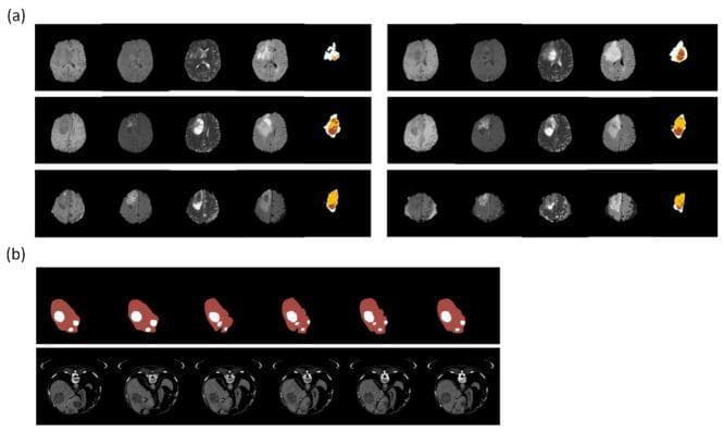 Educational comparison of medical imaging datasets for machine learning segmentation. (a) Brain Tumor Segmentation (BraTS) series demonstrating axial MRI modalities of glioblastoma multiforme. From left to right: T1-weighted (showing tumor hypointensity), T1-contrast enhanced (T1ce) (showing peripheral ring enhancement), T2-weighted (showing hyperintense tumor and edema), and FLAIR (Fluid-Attenuated Inversion Recovery) (suppressing CSF signal to highlight peritumoral edema). The rightmost column shows ground truth annotations: red for necrosis, yellow for active tumor, and white for perifocal edema. (b) Liver Tumor Segmentation (LiTS) series demonstrating axial CT scans of the upper abdomen. The bottom row shows raw CT images with visible hypodense hepatic lesions. The top row provides corresponding segmentation masks, where the liver parenchyma is outlined in red and hepatic tumors are marked in white. This clinical material is designed for training deep learning models in neuroradiology and abdominal radiology segmentation tasks.