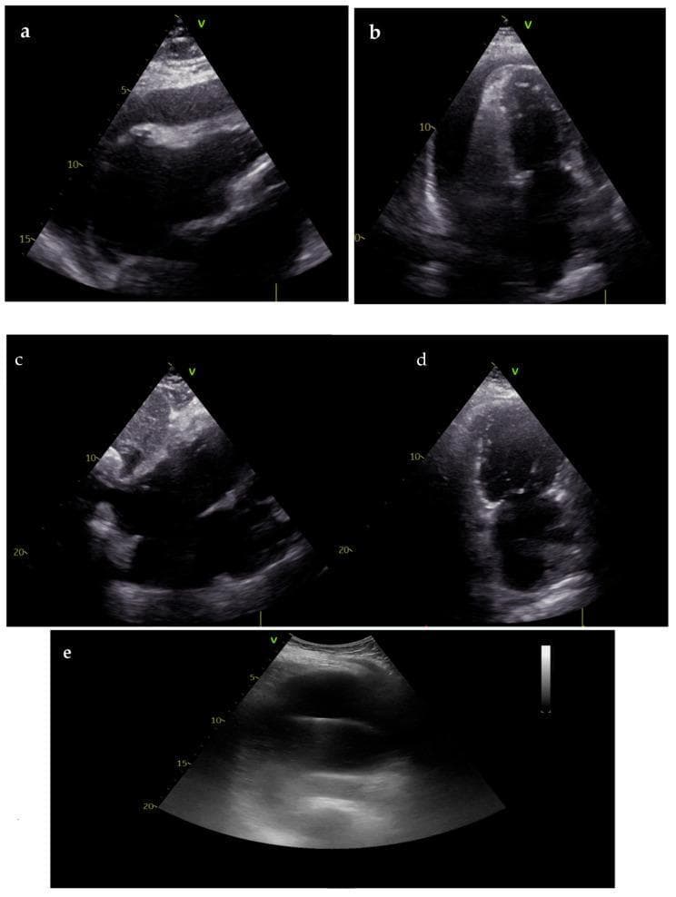 This composite of transthoracic echocardiogram (TTE) images illustrates the diagnosis, procedural management, and resolution of cardiac tamponade. Panels (a) and (b) show parasternal long-axis and apical views during cardiac arrest, revealing a large, circumferential anechoic pericardial effusion. Key diagnostic features include visible compression of the right heart chambers (atrial and ventricular collapse), indicative of high intrapericardial pressure causing tamponade. Panel (c) demonstrates an ultrasound-guided pericardiocentesis, showing the insertion of the drainage needle into the pericardial space. Panels (d) and (e) represent the post-resuscitation phase, displaying near-complete resolution of the pericardial effusion and restoration of normal cardiac chamber dimensions and filling. This series highlights the critical role of Point-of-Care Ultrasound (POCUS) in identifying reversible causes of pulseless electrical activity (PEA) and facilitating life-saving interventions such as emergency pericardiocentesis.