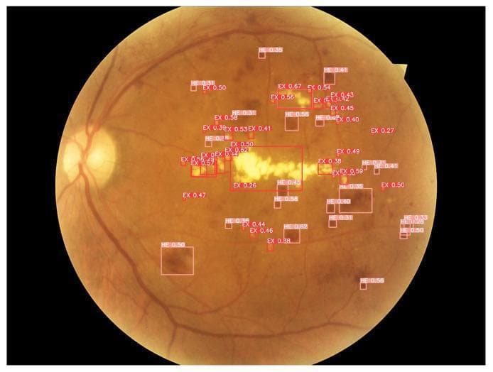 This diagnostic image is a color fundus photograph demonstrating clinical signs of diabetic retinopathy, including hard exudates (EX) and hemorrhages (HE). The fundus view shows the optic disc on the left and various retinal pathologies labeled with automated detection bounding boxes. A significant cluster of yellowish, waxy hard exudates is concentrated in the central macula and mid-peripheral regions, exhibiting morphology that ranges from small punctate spots to larger, coalesced amorphous plaques. Interspersed throughout the retina are multiple dark red hemorrhages, appearing as varying sizes of blotch-like and dot-like lesions. These findings indicate localized vascular leakage and retinal ischemia. The image serves as an educational example of automated lesion detection in ophthalmology, specifically identifying markers of non-proliferative diabetic retinopathy. The bounding boxes indicate machine learning classification of these features, highlighting the clinical significance of distribution and morphology in staging retinal vascular disease.