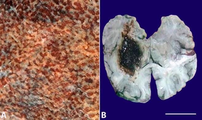 This composite clinical photograph displays two gross pathological specimens (labeled A and B) from a medical autopsy. Image A shows a close-up detail of a cut liver surface presenting a classic 'nutmeg liver' appearance. This is characterized by a variegated, mottled pattern with alternating red-brown areas (representing centrilobular congestion and necrosis) and lighter tan or yellowish-brown areas (representing relatively normal or fatty periportal parenchyma). Image B is a transverse cut section of a brain specimen showing a large, irregularly shaped, dark brown-to-black hematoma localized within the left basal ganglia. The lesion shows clear contrast against the paler surrounding cerebral tissue and demonstrates extension toward the ventricular system. A white scale bar representing 7 cm is provided in the bottom right corner of image B. These images illustrate gross manifestations of chronic passive venous congestion in the liver and a massive intracranial hemorrhage, which may be associated with systemic complications such as hemophagocytic lymphohistiocytosis (HLH) or severe infections like H1N1 influenza.