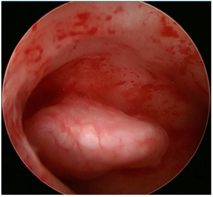 This clinical diagnostic image is a hysteroscopic view of the uterine cavity, showing an endometrial polyp. The image displays a smooth, rounded, and lobulated mass approximately 1.5 cm in size, situated on the right lateral wall of the uterus. The polyp exhibits a lighter, pinkish-white coloration compared to the surrounding pinkish-red uterine lining. Fine superficial blood vessels are visible on the surface of the polyp, which appears less vascular than the adjacent hyperemic endometrium. The surrounding uterine tissue shows evidence of mild spotting and irregular vascular patterns. This endoscopic finding is characteristic of a benign endometrial polyp, often investigated in cases of infertility or abnormal uterine bleeding. The image serves as an educational example of intrauterine pathology identified during a diagnostic hysteroscopy, illustrating the morphological differences between focal polyps and normal endometrial tissue.