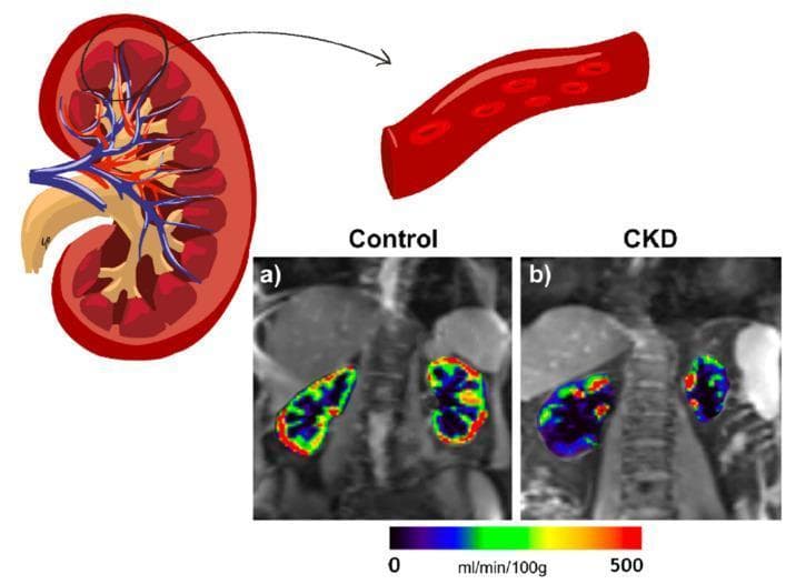 This educational image combines anatomical illustrations and diagnostic MRI imaging to demonstrate Renal Blood Flow (RBF). The upper section contains a sagittal anatomical diagram of a kidney showing cortical and medullary structures, and an inset illustrating arterial blood flow with red blood cells. The lower section presents two diagnostic images utilizing Arterial Spin Labeling (ASL) MRI to map perfusion. Panel (a) shows a 66-year-old healthy control, exhibiting robust, symmetrical RBF indicated by a warm color palette (green, yellow, red) ranging toward 500 mL/min/100g. Panel (b) depicts a 76-year-old patient with diabetes and Chronic Kidney Disease (CKD), showing significantly reduced perfusion. The CKD patient's kidneys exhibit a cooler color distribution (deep blue and purple), indicating lower RBF values closer to 0 mL/min/100g. Both maps are overlaid on M0 reference images, highlighting the clinical utility of non-invasive MRI techniques in assessing microvascular alterations and disease progression in diabetic kidney disease.