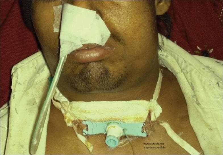 This clinical photograph displays a tracheostomy tube in situ within the anterior neck of an adult male patient. The tracheostomy tube features a light blue rectangular flange (plate) resting against the skin, secured by white gauze padding and a wide, off-white cotton tie that encircles the neck. The surgical site appears to be located just above the manubrium sterni, and there is visible suture material and some minor dried discharge near the flange edges. A translucent ventilator or T-piece tubing is connected to the tracheostomy cannula, extending upwards across the left side of the patient’s face. Additional clinical features include white medical tape and gauze obscuring the patient's nose and upper lip, likely related to prior airway management or nasogastric tube fixation. This procedural image demonstrates the management of a patient on spontaneous ventilation following surgical emphysema and tracheal wound dehiscence repair, highlighting standard tracheostomy fixation techniques in a post-surgical critical care setting.