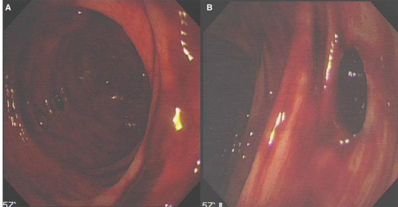 This clinical photograph consists of two endoscopic images (A and B) showing the findings of a bedside colonoscopy in a patient with lower gastrointestinal bleeding. Image A depicts the colonic lumen filled with fresh, dark-red blood coating the mucosal surface, which obscures fine vascular details and gives the lining a glistening, wet appearance. Image B shows a close-up of a colonic diverticulum, appearing as a dark, circular outpouching or orifice within the bowel wall. The surrounding mucosa is intensely erythematous and friable, with visible streaks of fresh blood and inflammatory changes. These images illustrate acute diverticular bleeding, a common cause of hematochezia. The clinical context involves a COVID-19 patient on high-dose corticosteroids, suggesting a potential relationship between severe systemic illness, medication-induced mucosal stress, and gastrointestinal complications. The visual evidence supports a diagnosis of lower GI hemorrhage originating from diverticulosis.