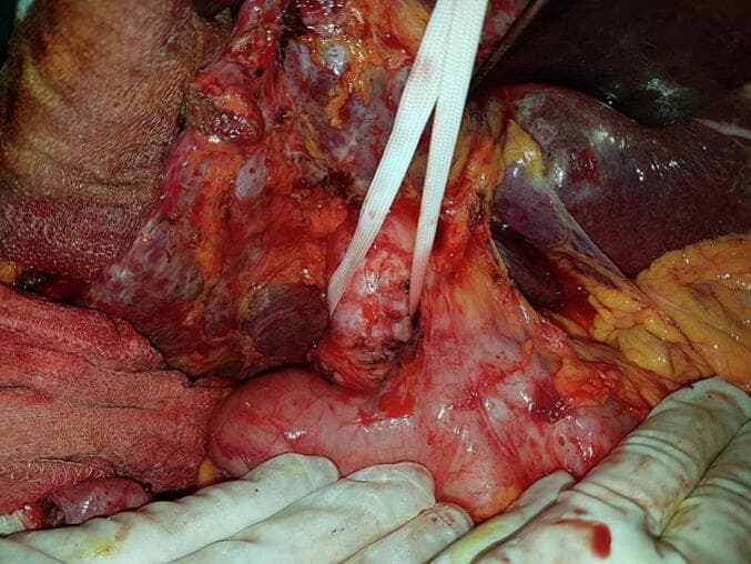 This clinical photograph shows an intraoperative view of the hepatobiliary region during a surgical procedure for acute cholangitis. The primary focus is a severely dilated common bile duct, which appears as a prominent, distended, tubular structure with a pinkish-white serosal surface and visible superficial vascularization. The duct is isolated and retracted using a white vessel loop (surgical tape). Adjacent to the dilated duct, the duodenum is visible as a bulbous, pink organ in the lower portion of the surgical field. The liver is seen in the upper right quadrant, exhibiting a dark reddish-purple color and glistening surface. The surrounding surgical field contains evidence of inflammation and adhesions, with varied textures including granular, fatty, and serosal tissues. The photograph demonstrates the anatomical distortion caused by chronic biliary obstruction and distal choledocholithiasis, illustrating the typical presentation of a dilated bile duct requiring surgical intervention such as choledocotomy or anastomosis.