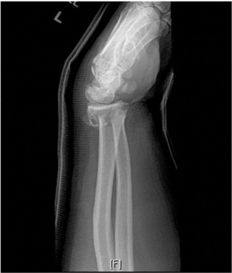 A diagnostic lateral X-ray of the left wrist demonstrating an acute, comminuted fracture of the distal radius. The distal radial fragment exhibits significant dorsal angulation and dorsal displacement, characteristic of a Colles-type injury pattern. There is associated cortical disruption and multi-fragmentary bone involvement at the metaphyseal-diaphyseal junction. Additionally, a displaced fracture of the ulnar styloid process is visible. The radiograph is taken through a dorsal splint or cast material, which is visible as a radiopaque shadow bordering the posterior aspect of the forearm and hand. This image is clinically significant for illustrating common orthopedic trauma following a fall on an outstretched hand (FOOSH), highlighting the loss of normal volar tilt and the resulting dorsal deformity. It serves as a classic educational example of unstable distal radius fractures requiring surgical consideration due to dorsal angulation and comminution.