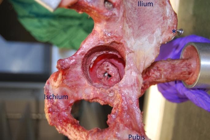 This clinical photograph shows a medial view of a right cadaveric hemipelvis specimen used in an orthopedic biomechanics study. The image highlights the internal pelvic anatomy, specifically identifying the ilium, ischium, and pubis. An asterisk marks the anterior superior iliac spine (ASIS) for orientation. Centrally, the medial wall of the acetabulum has been surgically opened (transpelvic portal) to reveal the intact hip capsule and acetabular fossa from the inside. The hip is positioned in a state of deep flexion, allowing for the visual assessment of the internal capsular structures. The specimen is mounted in a testing rig, visible via the femoral shaft extending to the right. This visual demonstrates a specialized surgical technique for total hip arthroplasty (THA) research, where components are implanted through the medial wall to preserve the entire native capsular ligamentous complex, facilitating the study of post-operative hip stability and range of motion.