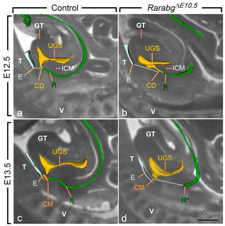 This comparative anatomical diagram utilizes sagittal High-Resolution Episcopic Microscopy (HREM) sections to illustrate the development of the cloaca in control and RarabgΔE10.5 mutant mouse embryos at developmental stages E12.5 and E13.5. The images emphasize the pathophysiology of anorectal malformations (ARM). Key anatomical labels include the urogenital sinus (UGS, yellow), rectum (R, green), cloacal duct (CD), and intra-cloacal mesenchyme (ICM). In control embryos (a, c), the UGS and rectum successfully separate and migrate toward the surface ectoderm. In mutant embryos (b, d), the UGS lumen is noticeably reduced at E12.5, and the ICM is hypoplastic. By E13.5, the mutant rectum (R*) fails to reach the ectodermal groove (E) and terminates blindly, separated from the surface by a thickened mesenchymal layer (indicated by dotted lines), while the UGS still communicates with the amniotic cavity at the cloacal membrane (CM). These findings demonstrate developmental arrest in cloacal septation and migration, providing a model for human anorectal agenesis.