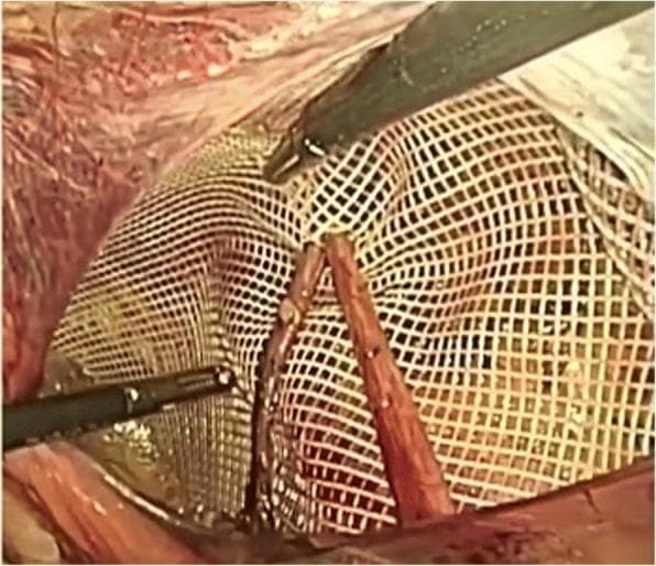 Laparoscopic intraoperative photograph demonstrating a 'key-holed' or slit mesh placement during a transabdominal preperitoneal (TAPP) or totally extraperitoneal (TEP) inguinal hernia repair. A white, rectangular polyester mesh with a macro-porous, grid-like structure is shown. The mesh has been vertically engraved to create a slit (keyhole), allowing it to be positioned around the spermatic cord structures, which are visible passing through the opening. Two laparoscopic graspers are seen: one superiorly manipulating the upper edge of the mesh and another inferiorly stabilizing the material. The background shows the dissected preperitoneal space, including the retroinguinal space of Bogros. This technique is designed to provide comprehensive coverage of the myopectineal orifice while accommodating the passage of the vas deferens and spermatic vessels to prevent entrapment or future recurrence. The surgical field displays typical anatomy of the posterior inguinal wall, used for teaching prosthetic reinforcement in hernia surgery.