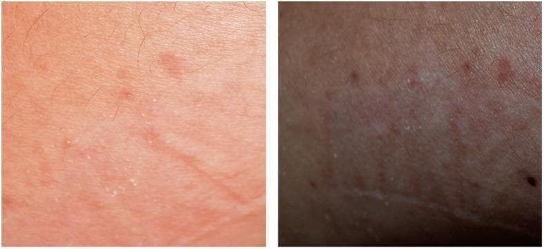 This clinical photograph consists of a side-by-side comparison of two skin sections demonstrating a Type IV delayed hypersensitivity reaction following a patch test with acrylic resin. The left image shows an acute-to-subacute phase characterized by diffuse erythema (redness) and fine desquamation (scaling/peeling). Small, scattered inflammatory papules are visible across the surface. The right image depicts a later or more chronic stage of the reaction, where the skin exhibits post-inflammatory hyperpigmentation, appearing darker and brownish. Persistent desquamation and small flakes of skin are evident in both panels, indicating surface texture abnormalities associated with allergic contact dermatitis. The image serves as an educational tool for identifying clinical signs of positive patch test results, specifically in the context of oral lichenoid reactions (OLR) triggered by dental materials like acrylic resin.