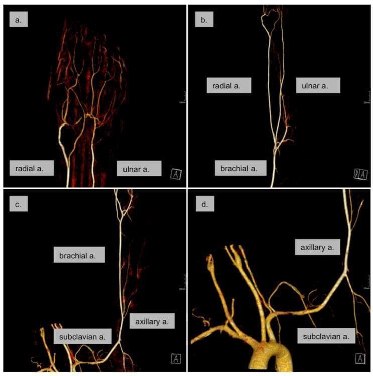 This diagnostic image consists of four panels (a–d) showing a 3D reconstruction of a Computed Tomography Angiography (CTA) of the left upper extremity and aortic arch. The series illustrates the arterial anatomy from the distal hand to the proximal chest. Panel (a) focuses on the hand, showing the superficial and deep palmar arches and digital arteries. Panel (b) depicts the forearm, highlighting the radial and ulnar arteries branching from the brachial artery. Panel (c) shows the mid-to-upper arm including the brachial, axillary, and distal subclavian arteries. Panel (d) displays the aortic arch with the origins of the great vessels, specifically focusing on the left subclavian and axillary arteries. The imaging demonstrates normal arterial diameters, smooth vessel walls, and continuous contrast opacification throughout the entire vascular tree. There is no evidence of thrombi, atherosclerotic plaques, or residual vasospasm. This CTA series is used to evaluate peripheral perfusion and rule out proximal embolic sources in clinical scenarios such as acute limb ischemia or Raynaud's phenomenon.