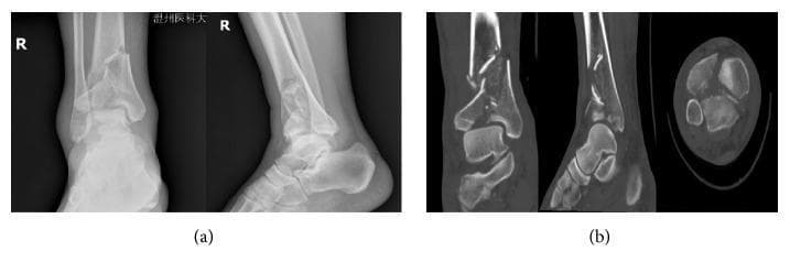A multi-panel radiological image displaying preoperative diagnostic imaging of a Pilon fracture. Section (a) contains anteroposterior (AP) and lateral X-ray views of the right ankle, showing a complex, displaced distal tibial fracture extending into the articular surface (tibial plafond). Disruption of the distal fibula is also suggested. Section (b) provides high-resolution CT scans in coronal, sagittal, and axial planes. These CT images reveal the extensive comminution and fragmentation of the distal tibia, clearly demonstrating the involvement of the articular surface and the degree of displacement among bone fragments. The images illustrate a high-energy traumatic injury, with the CT providing critical detail for preoperative planning by characterizing the specific fracture patterns and intra-articular extension that are less distinct on the initial radiographs. This visual serves as an educational example of advanced orthopedic trauma imaging for medical students and surgical residents specializing in traumatology.