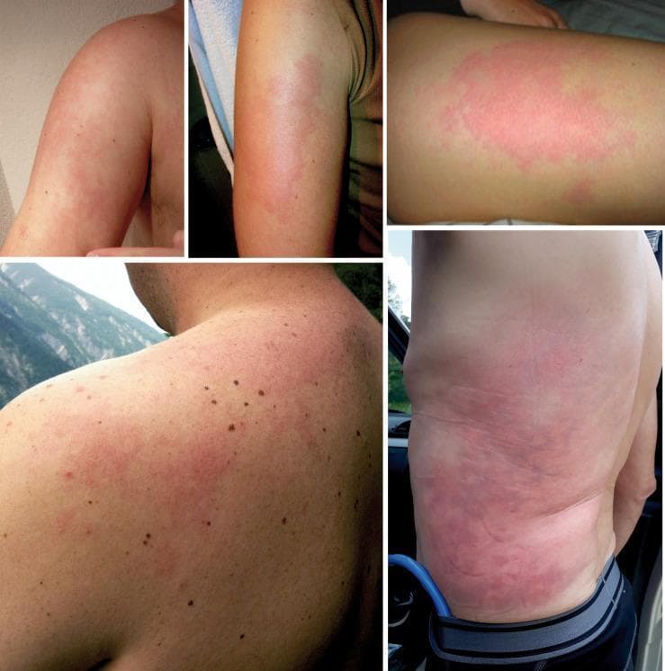 This composite of clinical photographs illustrates various presentations of Livedo racemosa (LRC) in the context of decompression illness (DCI). The images show affected skin on the upper arms, trunk, and back, characterized by a persistent, reddish-blue to violaceous mottling. The lesion morphology is defined by an irregular, 'broken' net-like or reticulated pattern that does not form complete circles, distinguishing it from livedo reticularis. These manifestations represent cutaneous decompression illness, where vascular occlusion by nitrogen gas bubbles or secondary microthrombi leads to focal perfusion deficiencies and venous congestion. The distribution is typically asymmetrical and can involve the limbs and trunk. Clinically, this sign is significant as it often correlates with a high prevalence of right-to-left shunts, such as a patent foramen ovale (PFO), in diving-related injuries.