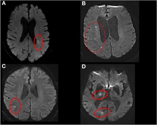 Diagnostic axial brain MRI series utilizing Diffusion-Weighted Imaging (DWI) to illustrate various topographical patterns of acute ischemic stroke. The figure is divided into four panels, with hyperintense lesions (indicative of restricted diffusion) highlighted by red circles. Panel A demonstrates a single subcortical infarct, appearing as a localized hyperintensity in the periventricular white matter. Panel B shows multiple subcortical infarcts, characterized by scattered, small hyperintense foci throughout the deep white matter. Panel C identifies a cortical infarct, where the hyperintensity is confined to the cerebral cortex. Panel D illustrates non-confluent cortical-subcortical infarcts, featuring two distinct, non-adjacent hyperintense lesions—one in a cortical region and another in a deeper subcortical structure. This radiological series serves as an educational tool for neuroradiology and neurology to differentiate stroke mechanisms based on infarct distribution, aiding in the classification of vascular territories and lesion morphology.