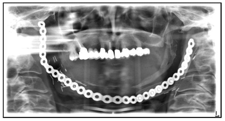 This panoramic dental X-ray (orthopantomogram) displays extensive surgical intervention and reconstruction of the mandible. A prominent, large-caliber metallic reconstruction plate with multiple circular screw holes spans the entire lower border of the mandible from the right to the left ramus. The image reveals significant continuity defects: there is a complete absence of native bone structure on the left side of the mandible and a marked discontinuity on the right, consistent with radical resection. The reconstruction plate is secured to the remaining mandibular segments with multiple screws; notably, some screws appear fractured or displaced. Visible radiopaque metallic clips are also scattered near the surgical site. The maxillary dentition remains relatively intact, showing normal alignment and restorations. The clinical significance of this imaging is to demonstrate post-surgical management of Medication-Related Osteonecrosis of the Jaw (MRONJ), highlighting the challenges of re-osteosynthesis following the failure of previous fibula grafts due to chronic inflammation and osteolysis.