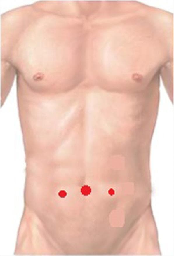 This medical illustration depicts the standard trocar port placement for laparoscopic inguinal hernia repair on a male torso. The diagram uses red circular markers to indicate surgical entry points. A primary 10 mm trocar port is positioned centrally at the umbilicus. Two secondary 5 mm working ports are located bilaterally in the lower abdominal quadrants. These lateral ports are situated along the midclavicular lines, approximately 1 cm inferior to the horizontal umbilical line. This configuration is typical for providing optimal triangulation and visualization of the preperitoneal space (including Retzius and Bogros spaces) during minimally invasive abdominal surgery. The anatomical focus is on the lower abdominal wall and the geometric relationship between the umbilicus and midclavicular landmarks for surgical access.