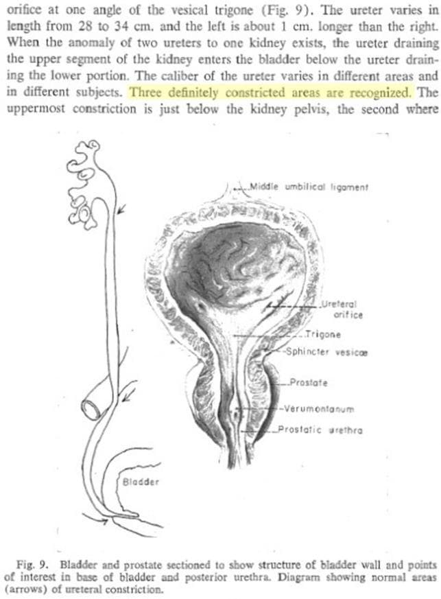 This medical illustration depicts the gross anatomy of the male lower urinary tract, focusing on the kidneys, ureters, bladder, and prostate. The diagram specifically highlights the historical anatomical concept of three physiological ureteral constrictions (indicated by arrows): the ureteropelvic junction (UPJ), the crossover of the iliac vessels (pelvic inlet), and the ureterovesical junction (UVJ) where the ureter enters the bladder. A detailed coronal section of the bladder and prostate is shown, labeling internal landmarks including the ureteral orifice, vesical trigone, sphincter vesicae, verumontanum, and prostatic urethra. The image demonstrates the spatial relationship where the bladder is positioned superior to the prostate, with the ureters descending retroperitoneally to insert into the posterior-inferior bladder wall. This diagram serves as a primary educational resource for urology and anatomy, illustrating common sites where urinary calculi may lodge and the internal structure of the bladder neck and posterior urethra.