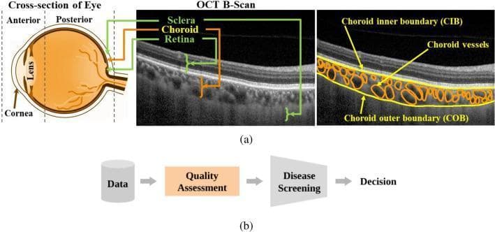 This educational graphic illustrates the anatomical and diagnostic visualization of the posterior segment of the human eye. Section (a) contains three panels: a sagittal cross-sectional diagram of the eye showing the anterior (cornea, lens) and posterior segments; a sample Optical Coherence Tomography (OCT) B-scan identifying the retina (innermost), choroid (middle), and sclera (outermost); and an annotated OCT B-scan specifically delineating the choroid. The annotated scan highlights the choroidal inner boundary (CIB), the choroidal outer boundary (COB) at the choroid-sclera interface, and individual choroidal vessels within the vascular stroma. Section (b) presents a diagnostic flowchart for clinical decision-making, emphasizing 'Quality Assessment' as a mandatory intermediary step between data acquisition and disease screening. This material is designed for ophthalmology education, focusing on retinal imaging, choroidal biomarker quantification (such as thickness and vascularity index), and the importance of image quality in automated diagnostic pipelines for conditions like central serous chorioretinopathy and age-related macular degeneration.