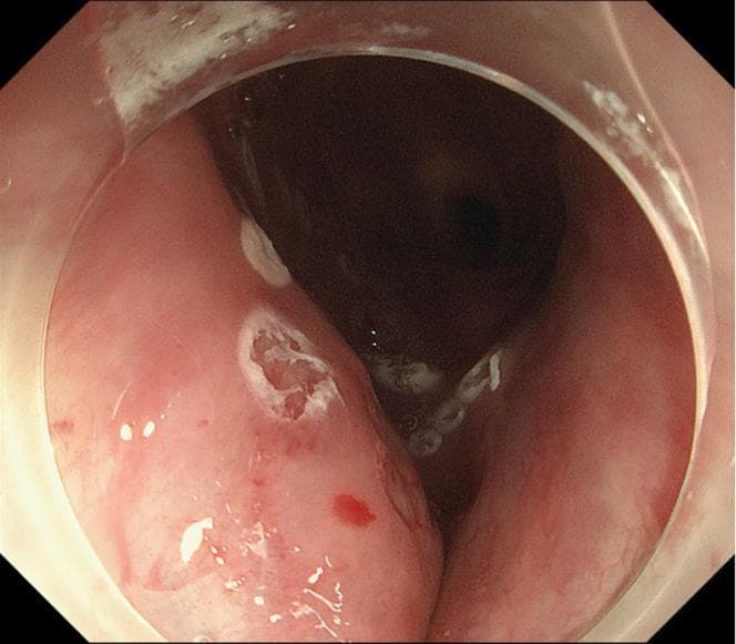This endoscopic image displays the cervical esophagus during an Endoscopic Submucosal Dissection (ESD) procedure for squamous cell carcinoma. The primary focus is a depressed, irregular lesion within the esophageal lumen, which has been demarcated by white, ring-shaped circumferential thermal markings. These cautery spots define the resection margins. The mucosal tissue appears erythematous and edematous, consistent with inflammatory changes. At approximately the 10 o'clock position, a distinct mucosal defect or superficial ulceration is visible, characterized by a pale, granular base and slightly raised, irregular borders. Small focal areas of petechiae and subepithelial hemorrhage are noted on the surrounding pinkish mucosa. The image is captured through a transparent distal attachment (hood), facilitating better visualization of the esophageal folds and the anatomical depth of the depressed region. This visual serves as an educational example of preoperative lesion mapping and endoscopic site preparation in a patient with a complex anatomical history involving previous surgery and radiotherapy.