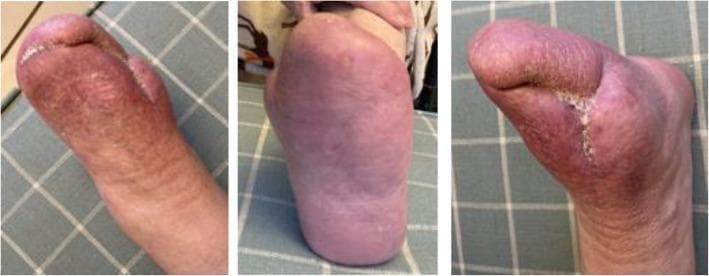 Clinical photograph showing three views (dorsal, plantar, and medial/lateral) of a left foot 18 months after percutaneous Deep Vein Arterialization (pDVA) for chronic limb-threatening ischemia (CLTI). The foot demonstrates successful salvage and complete epithelialization following a transmetatarsal amputation and previous toe debridement. Visually, the skin across all views exhibits a healthy, pinkish-red hue indicative of adequate distal perfusion. The plantar view shows smooth, intact skin without active ulceration. The dorsal and side views reveal a well-healed, linear surgical scar at the amputation site with well-approximated edges and no signs of inflammation, infection, or necrotic tissue. The educational focus of the image is to demonstrate the long-term clinical outcome and wound healing success of pDVA in a diabetic patient with severe calcific occlusive disease, showing the preservation of the foot and resolution of ischemic rest pain.