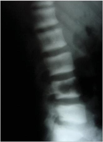 A lateral view X-ray of the lumbar spine illustrating the 'rugger jersey spine' sign. The radiograph reveals a characteristic pattern of alternating radiopacity within the vertebral bodies. Specifically, there are prominent horizontal bands of increased bone density (osteosclerosis) located at the superior and inferior endplates of each vertebra. These sclerotic bands contrast with the relatively radiolucent (normal to osteopenic) central portion of the vertebral bodies, creating a striped appearance reminiscent of a rugby jersey. This finding is highly indicative of renal osteodystrophy secondary to chronic kidney disease or hyperparathyroidism. The image demonstrates the structural skeletal manifestations of systemic metabolic bone disease, focusing on the lumbar region's vertebral architecture and density distribution.