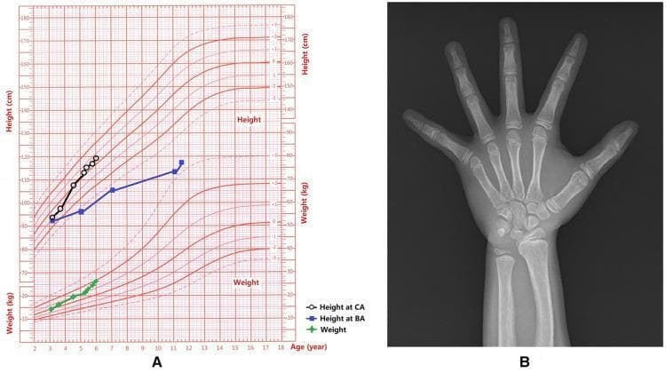 This composite educational graphic contains two panels documenting a pediatric patient's growth and skeletal development. Panel A is a standardized Growth Chart plotting height and weight against age (2 to 18 years). It tracks three parameters: Height at Chronological Age (CA) shown by open circles, Height at Bone Age (BA) shown by blue squares, and weight shown by green plus signs. The data indicates an accelerated growth velocity where BA significantly exceeds CA, and height and weight trend above the standard deviation curves. Panel B is a posterior-anterior (PA) view diagnostic X-ray of the left hand and wrist used for bone age assessment. The radiograph demonstrates a bone age advanced beyond the chronological age of 5.3 years (to approximately 10.5 years). Morphological findings include a slight Madelung deformity, characterized by a shortened radius with a volar and ulnar tilt of the distal radial articular surface and relative prominence of the distal ulna. The carpal bones show advanced ossification consistent with the BA assessment.