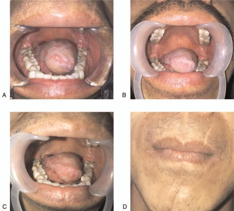 This composite of four clinical photographs documents the postoperative recovery and reconstruction following a partial glossectomy for adenoid cystic carcinoma. Panels A, B, and C provide a longitudinal intraoral view of the tongue reconstruction using an anterolateral thigh (ALT) free flap at 3, 6, and 12 months, respectively. Panel A displays a bulky, smooth-surfaced flap occupying much of the oral floor. By Panel B, the flap shows initial atrophy and increased surface texture. Panel C demonstrates further volume reduction and naturalization of the tongue contour, showing visible folds and a central sulcus-like depression, which facilitates improved speech and swallowing. Panel D is an extraoral facial photograph at 12 months post-surgery, illustrating the healed surgical site. A faint, mature linear scar is visible extending horizontally across the upper lip and philtrum, with subtle changes in skin texture and pigmentation compared to the surrounding perioral tissue. The series demonstrates the success of microvascular free flap reconstruction in restoring oral architecture and achieving functional rehabilitation after major oncological resection in the head and neck region.