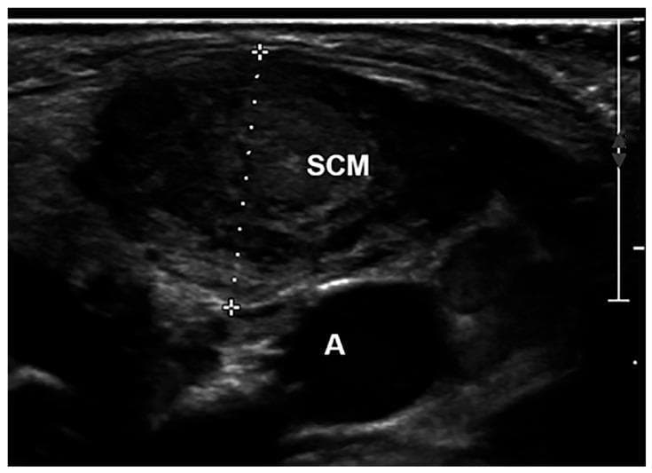 This diagnostic ultrasound image in the transverse plane depicts the anatomy of the neck, specifically focusing on the sternocleidomastoid muscle (SCM) and adjacent structures. The SCM is centrally featured, displaying a heterogeneous, elliptical morphology characterized by internal speckle artifacts typical of muscular tissue. White calipers and a dotted vertical line indicate a measurement of the SCM thickness, spanning the distance between the superficial and deep aponeurosis. Situated inferior and medial to the SCM is a well-defined anechoic (black) circular structure labeled 'A', representing the carotid artery, which serves as a key vascular landmark. The image includes a depth scale on the right margin for quantitative reference. This clinical imaging is representative of diagnostic protocols used in pediatrics to assess musculoskeletal conditions such as congenital muscular torticollis, allowing for the objective measurement of muscle fibrosis or hypertrophy relative to contralateral normal tissue.
