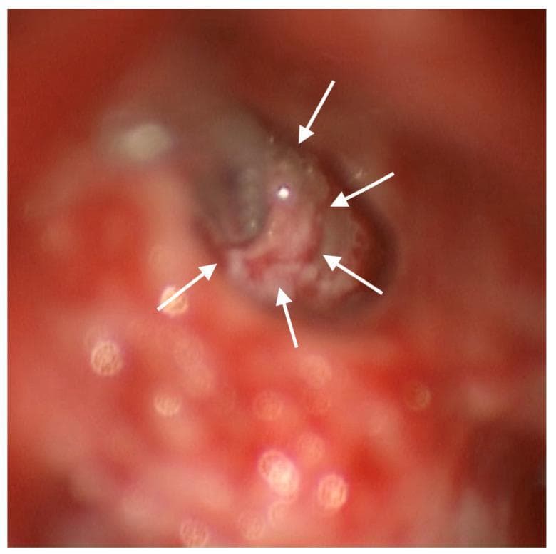 This intraoperative clinical photograph shows a posterior tympanotomy surgical approach to the middle ear during a cochlear reimplantation procedure. The focus is on the round window (RW) region, which has been surgically enlarged to facilitate electrode insertion. A cochlear implant electrode array is visible entering the cochlea through the modified RW opening. Five white arrows indicate a dense mass of light-colored, whitish connective tissue that has been intentionally placed to envelop the electrode array at the entry site. This connective tissue serves as a biological barrier between the implant and the bony margins of the enlarged round window, intended to prevent future osteoneogenesis or fibro-ossification that could damage the device. The surrounding field shows typical erythematous surgical margins of the middle ear mucosa and temporal bone drilling site. This image demonstrates soft-tissue surgical techniques used in revision otologic surgery to manage and prevent implant failure due to reactive tissue formation.