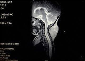 This diagnostic image is a sagittal T2-weighted contrast-enhanced magnetic resonance imaging (MRI) scan of a pediatric patient's head and neck. The image reveals a prominent, well-circumscribed soft tissue mass located in the posterior aspect of the neck, situated within the cutis and subcutaneous tissues. The mass exhibits a lobular morphology and is characterized by marked inhomogeneous hyperintensity on this T2 sequence, suggesting high vascularity or fluid content with internal septations or varying tissue density. Key anatomical landmarks visible include the cervical spine, cerebellum, and brainstem. Notably, the mass is clearly demarcated from the deeper musculoskeletal structures and does not show evidence of invasion or propagation toward the spinal canal or the prevertebral fascia. This appearance is clinically consistent with a benign vascular tumor, such as a large infantile hemangioma (capillary hemangioma), and illustrates the importance of contrast-enhanced MRI in evaluating the depth and vascular characteristics of pediatric soft tissue tumors.