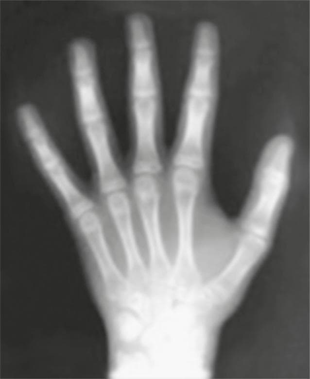 This diagnostic image is a posterior-anterior (PA) x-ray radiograph of a pediatric left hand and wrist, utilized for skeletal maturation and bone age assessment. The radiograph clearly depicts the distal radius and ulna, the carpal bones, metacarpals, and phalanges. Key educational features include the presence of open epiphyseal plates (growth plates) at the distal ends of the radius and ulna, as well as at the bases of the phalanges and the heads of the metacarpals. Specifically, the image is used to identify the 'IJ stage' of radial maturation according to the Hagg and Taranger method, which correlates skeletal development with the pubertal growth spurt. This stage is characterized by the initial fusion or specific morphological changes in the distal radial epiphysis. The visualization of these ossification centers is critical in orthodontics and pediatric orthopedics to determine biological age and predict remaining facial or systemic growth potential.