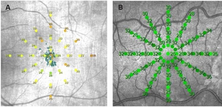 This diagnostic image displays two comparative grayscale fundus photographs (A and B) overlaid with microperimetry stimulus grids, used to assess macular functional sensitivity. Panel A illustrates a custom stimulus grid consisting of 33 test points arranged in a radial pattern at eccentricities of 0°, 1°, 3°, 5°, and 7° from the foveal fixation point. The points are color-coded (yellow, orange, green) to represent threshold sensitivity values in decibels (dB), superimposed on a macular region showing subtle pigmentary changes and central drusen characteristic of intermediate age-related macular degeneration (iAMD). Panel B shows a higher-density normative database grid (MAIA) with 61 points located at 0°, 1°, 2°, 3°, 4°, and 5° from fixation. In this panel, the points are uniform in color (green) and labeled with numerical sensitivity values. Both grids are centered on the macula, demonstrating the spatial distribution of functional testing relative to retinal vascular landmarks. These visuals serve as educational tools for understanding retinal sensitivity mapping in macular pathology and comparing different perimetric protocols.
