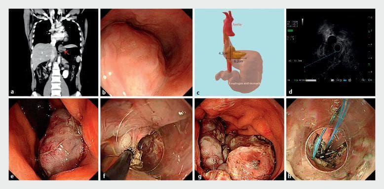 This composite figure illustrates the multi-modal diagnostic and surgical management of an esophageal leiomyoma at the esophagogastric junction. (a) Coronal CT scan shows a low-density mass (red arrow) near the mediastinal-abdominal transition. (b) White-light endoscopy reveals a large submucosal bulge with smooth, intact overlying mucosa. (c) A 3D anatomical reconstruction maps the 4.3 cm x 6.2 cm tumor's relationship to the aorta and stomach. (d) Endoscopic ultrasound (EUS) characterizes the lesion as a hypoechoic mass originating from the muscularis propria. (e-f) Intraoperative endoscopic images demonstrate the resection process: the tumor is detached from the muscular layers using a HookKnife and snare-assisted traction. (g) The excised specimen is shown segmented within the gastric lumen prior to extraction. (h) The final panel shows the closure of the mucosal defect using the kissing suture technique with endoscopic clips and sutures. This series highlights the progression from diagnostic imaging and EUS localization to complete endoscopic resection of a gastrointestinal stromal-type tumor.