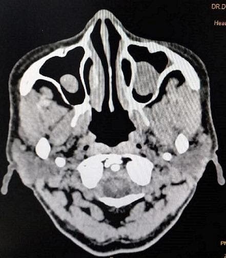 This diagnostic image is an axial non-contrast Computed Tomography (CT) scan of the paranasal sinuses. The scan demonstrates bilateral abnormalities within the maxillary and ethmoidal sinuses. Specifically, there is prominent mucosal thickening characterized by ill-defined, heterogeneous soft tissue signal intensity that partially opacifies the normally air-filled sinus cavities. The thickening is visible along the walls of both the right and left maxillary sinuses, appearing denser than air but less dense than cortical bone. The ethmoidal air cells also show evidence of soft tissue density, indicating inflammatory or infectious processes such as sinusitis. These findings are clinically significant in the context of paranasal sinus disease and are used to evaluate the extent of sinonasal involvement prior to interventions like Functional Endoscopic Sinus Surgery (FESS). The image serves as an educational example of radiologic manifestations of chronic or acute inflammatory sinus pathology.