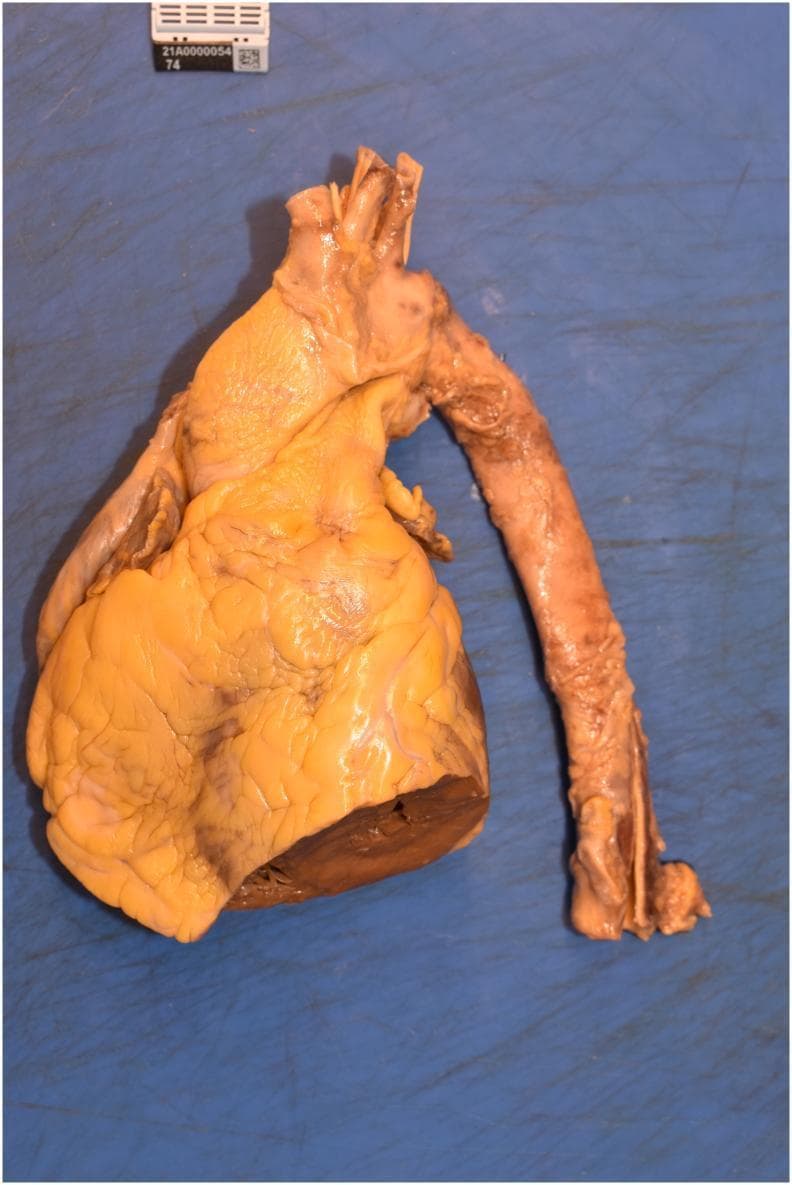 A clinical gross pathology specimen showing a human heart and a dissected segment of the thoracic and descending aorta during a necropsy study. The heart exhibits a prominent yellowish hue across the epicardial surface, consistent with significant epicardial fat accumulation. The surface texture appears lobulated with visible sulci corresponding to the anatomical pathways of the coronary arteries. A transverse cut at the inferior aspect of the ventricles reveals the dark brown, muscular myocardium of the ventricular wall. Attached to the superior aspect of the heart is the aortic arch, leading into a longitudinally dissected segment of the descending thoracic aorta. The aortic wall shows a transitioning color from pale tan at the root to a mottled reddish-brown along its length. The intimal surface of the aorta displays mild irregularities and roughness, indicative of early atherosclerotic changes, though no large aneurysms or obstructive thrombi are visible. The specimen is photographed against a blue surgical background with a scale marker for forensic and pathological documentation.