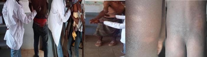 This composite of clinical photographs illustrates the physical examination process for leprosy (Hansen’s disease) in a community health setting. The images show healthcare professionals in white coats performing dermatological and neurological assessments on patients of varying ages. Key clinical features depicted include several hypopigmented, ill-defined anesthetic or hypoesthetic skin patches on the trunk and extremities, which are cardinal signs of the disease. The examination process shown includes visual inspection of the skin, palpation for thickened peripheral nerves, and sensory testing to identify loss of sensation within the lesions. Close-up panels highlight the morphological characteristics of the macules, showing a distinct contrast against the surrounding unaffected skin. This material is used to demonstrate active case-finding techniques and the clinical manifestations of leprosy, such as paucibacillary or multibacillary lesions, in endemic regions.