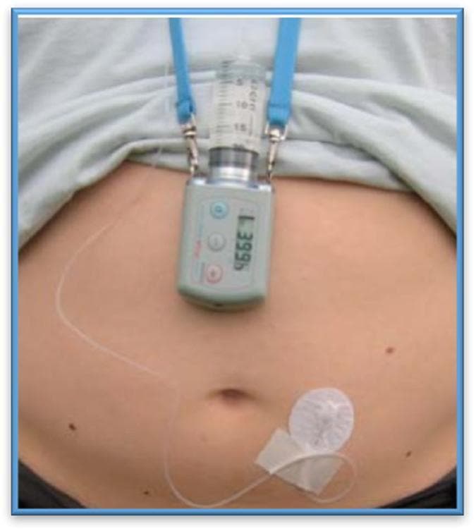 This clinical photograph demonstrates a continuous subcutaneous infusion system for medical therapy, specifically identified as an apomorphine pump for Parkinson's disease. The apparatus consists of a portable electronic infusion pump equipped with a digital display, attached to a 20 mL syringe containing a clear liquid medication. The device is suspended from the patient's neck by a blue lanyard. A thin, transparent infusion line extends from the pump and terminates at a subcutaneous insertion site on the lower right abdomen. The insertion site is secured with a specialized circular adhesive dressing featuring a white central stabilization component. This procedural image illustrates a non-oral delivery method used to manage motor fluctuations and 'off' periods in advanced Parkinson’s patients where gastrointestinal absorption of oral levodopa may be impaired. The image serves as an educational resource for medical students and clinicians specializing in neurology and movement disorders to understand the practical application of continuous subcutaneous drug delivery systems.