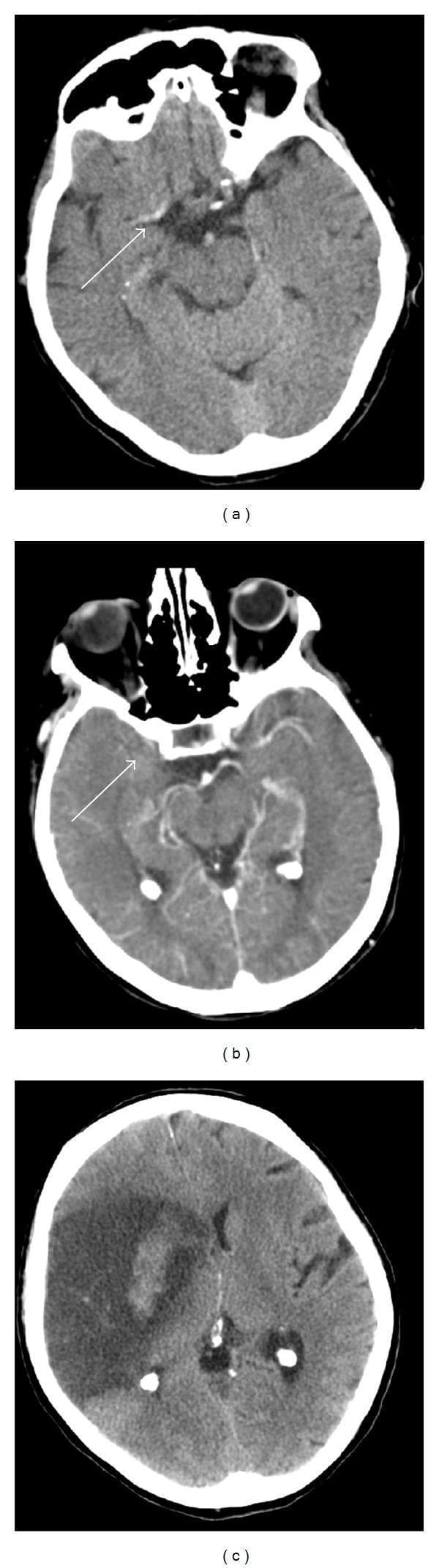 This composite of axial brain imaging illustrates the progression of an acute ischemic stroke to hemorrhagic transformation. (a) Non-contrast axial CT scan demonstrating the 'hyperdense MCA sign' in the right middle cerebral artery (white arrow), an early indicator of acute thromboembolism. There is a subtle loss of grey-white matter differentiation in the right insular cortex and basal ganglia, indicating early cytotoxic edema. (b) CT angiography (CTA) maximum intensity projection (MIP) confirming a proximal occlusion of the right M1 segment of the MCA (white arrow). (c) Follow-up non-contrast CT scan showing a large area of low attenuation (hypodensity) throughout the right MCA territory consistent with established infarction. Within this hypodense region, focal areas of hyperdensity are present, diagnostic of hemorrhagic transformation (HT). This series serves as an educational example of neuroradiological findings in large vessel occlusion and subsequent reperfusion injury or spontaneous bleeding within infarcted cerebral tissue.
