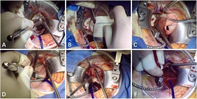 A composite of six intraoperative clinical photographs (A-F) documenting the key stages of a Right Minithoracotomy Bentall Procedure. (A, B) Focus on the aortic annulus, demonstrating the placement of interrupted mattress sutures using 2-0 poly(ethylene terephthalate) with gaskets to secure the proximal graft. (C) Shows the coronary anastomosis of the left main artery to the vascular graft performed in a continuous running fashion with 5-0 polypropylene. (D) Illustrates the subsequent right main coronary artery anastomosis, also utilizing a running 5-0 polypropylene suture technique. (E) Depicts the distal anastomosis between the vascular graft and the native ascending aorta using 4-0 polypropylene in a running fashion, with surgical tools like a nerve hook used for suture tension management. (F) Captures the final de-airing process of the left ventricle and aortic root graft using a venting needle prior to the removal of the aortic cross-clamp. This series illustrates a minimally invasive approach to aortic root replacement including valve and ascending aorta reconstruction.