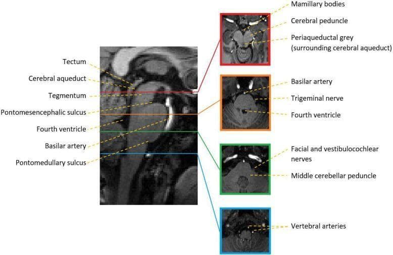 This diagnostic image provides a comprehensive anatomical overview of the human brainstem using T1-weighted MRI. On the left, a mid-sagittal section highlights the vertical arrangement of the midbrain, pons, and medulla. Key landmarks labeled include the tectum, cerebral aqueduct, tegmentum, and the fourth ventricle. Boundary demarcations such as the pontomesencephalic sulcus and the pontomedullary sulcus are clearly identified. To the right, four corresponding axial cross-sections are presented to illustrate internal and adjacent structures at specific levels. The superior axial view (midbrain) labels the mamillary bodies, cerebral peduncle, and periaqueductal grey. The second view (upper pons) identifies the basilar artery, trigeminal nerve, and fourth ventricle. The third view (lower pons/junction) shows the facial and vestibulocochlear nerves alongside the middle cerebellar peduncle. The most caudal axial view (medulla) highlights the vertebral arteries. This educational graphic is designed to teach brainstem spatial relationships, neuroanatomy, and neuroradiological landmarks for clinical localization.